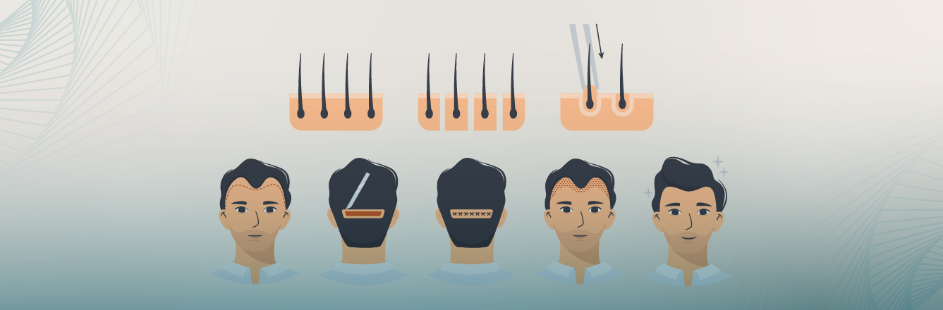 How does DHI hair transplantation - with Choi Pens work